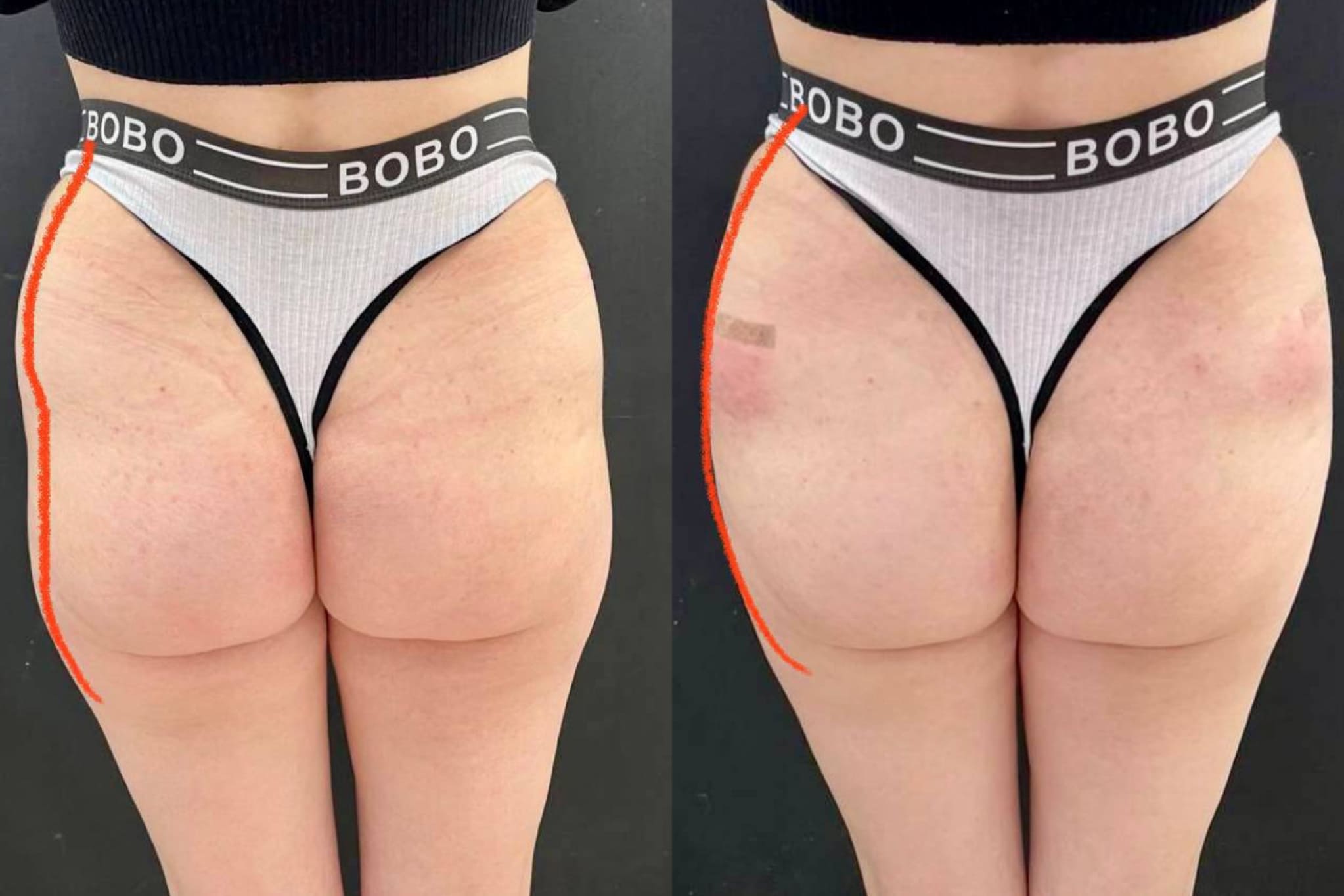 Увеличение ягодиц филлерами