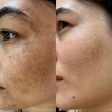 Инновация против пигментации: пилинг MELINE