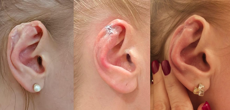 Фото до и после Восстановление ушной раковины после травмы