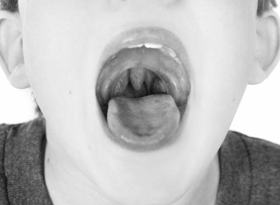 Холодно-плазменная аденотомия: современный и бережный подход к удалению аденоидов