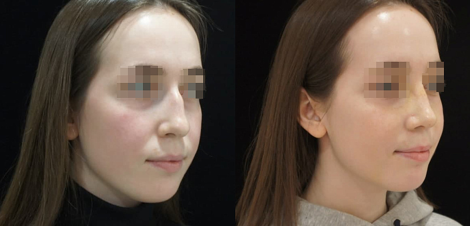 Ринопластика - Фото до и после процедуры пластики носа в клинике косметологии Effi в Красноярске. У пациента убрали горбинку носа, нос стал более миниатюрным (фото прямо)