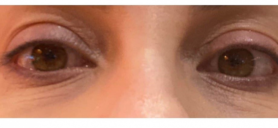 Фото до и после Лазерное омоложение кожи вокруг глаз