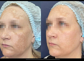 Хочу ровный, здоровый цвет лица