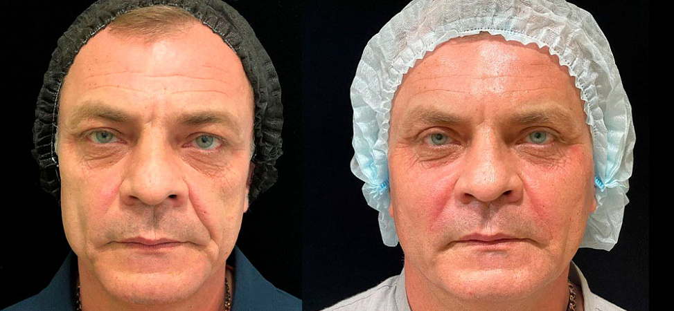 Фото до и после Контурная пластика лица