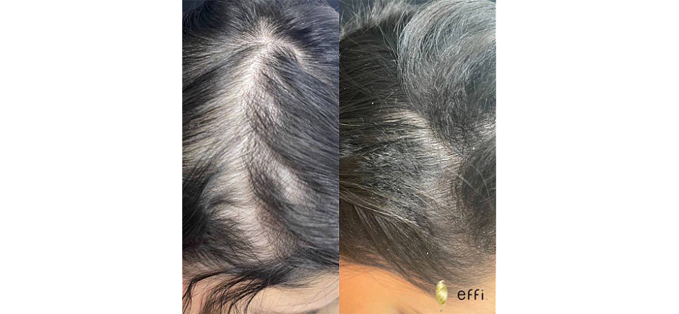 Фото до и после Мезотерапия для волос