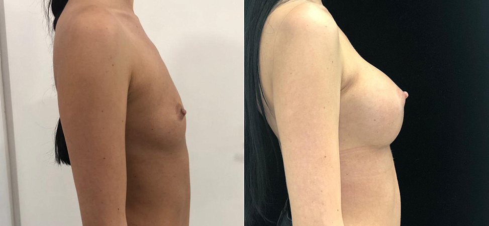 Фото до и после Увеличение груди