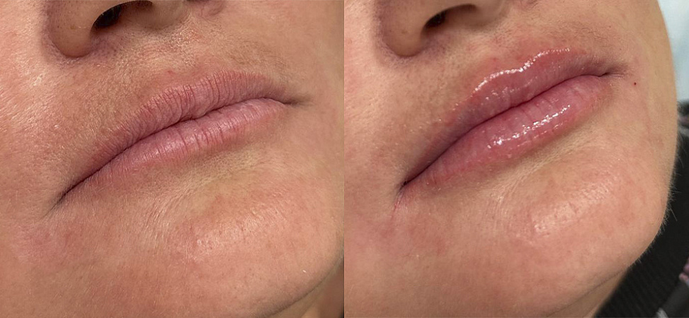 Фото до и после Увеличение губ