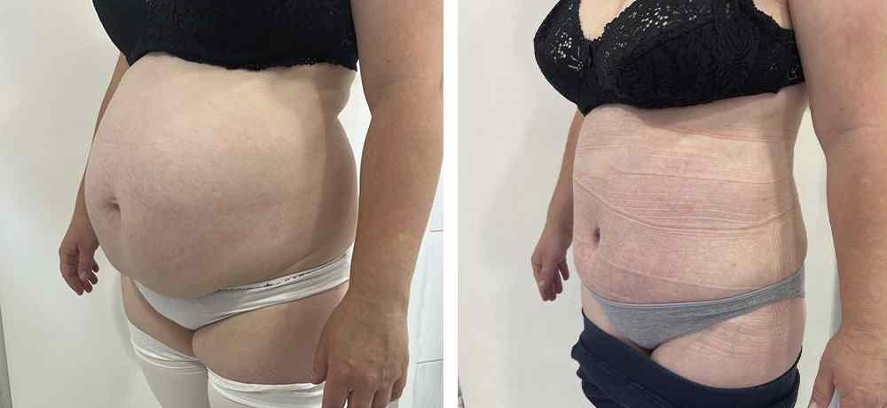 Абдоминопластика живота - фото до и после (полуанфас справа) операции абдоминопластики живота и боков в клинике косметологии Effi - врач Семенов. Наши хирурги имеют многолетний опыт работы.