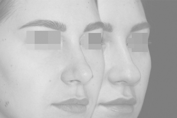 Ринопластика ноздрей (коррекция крыльев носа)