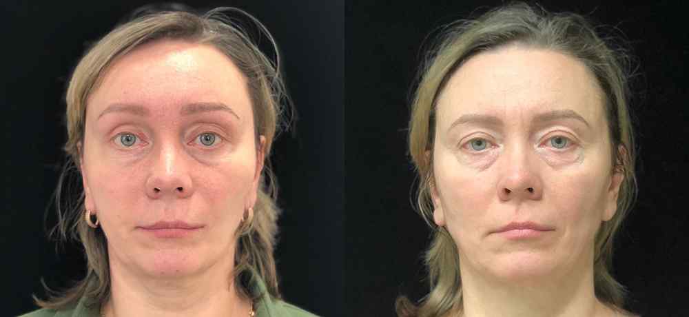 Чик лифтинг - фото до и после операции подтяжки лица у женщины (лифтинг овала лица) в клинике косметологии Effi в Красноярске. Подтяжка лица: убрать мешки под глазами, носогубные складки, обвисшую и дряблую кожу, снизилась эластичность кожных покровов, оп