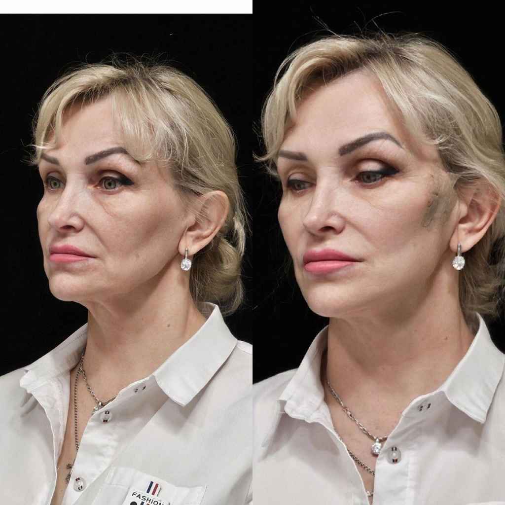 Нитевой лифтинг в Красноярске – Фото сбоку лица до и после процедуры нитевого лифтинга в клинике Еffi в Красноярске .Вернулось четкость лица, ушли брыли, глубокие морщины и носогубные складки, подтянулись уголки губ . Наши врачи имеют большой опыт работы