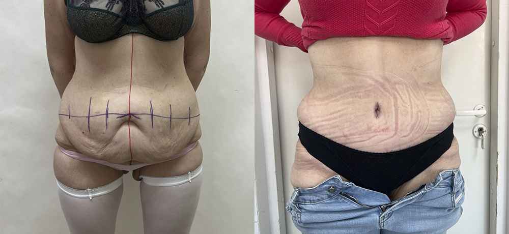 Абдоминопластика живота - фото до и после  операции липосакции живота и боков в клинике косметологии Effi в Красноярске - врач Семенов.