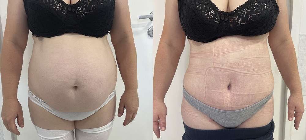 Абдоминопластика живота - фото до и после абдоминопластики живота и боков в клинике косметологии Effi - врач Семенов. На примере пациента. Наши хирурги имеют многолетний опыт работы.
