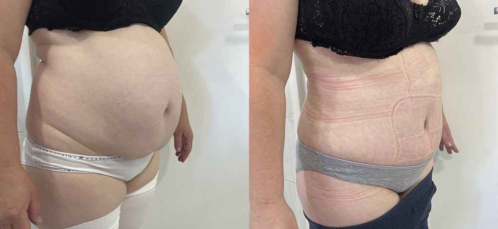 Абдоминопластика живота - Фото до и после (полуанфас) операции абдоминопластики живота и боков в клинике косметологии Effi - врач Семенов. Наши хирурги имеют многолетний опыт работы.