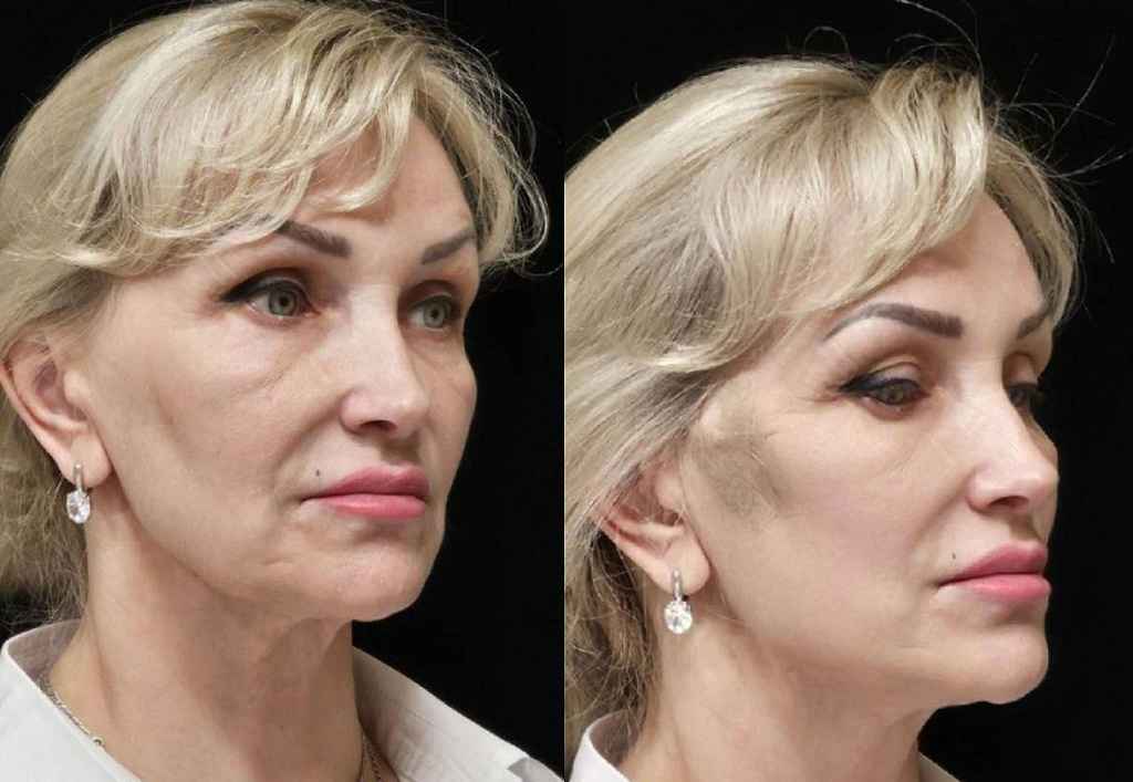 Нитевой лифтинг в Красноярске – Фото сбоку лица до и после процедуры нитевого лифтинга в клинике Еffi в Красноярске. Вернулся контур лица, скулы стали более четкими, глубокие морщины и носогубные складки, подтянулись уголки губ . Наши врачи имеют большой