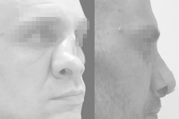 Восстановление симметрии носа
