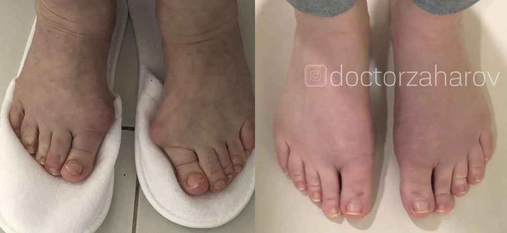 Операция лечения вальгусной деформации стопы (Hallus Valgus) - фото до и после операции  по выпрямлению пальца в клинике косметологии Effi в Красноярске.