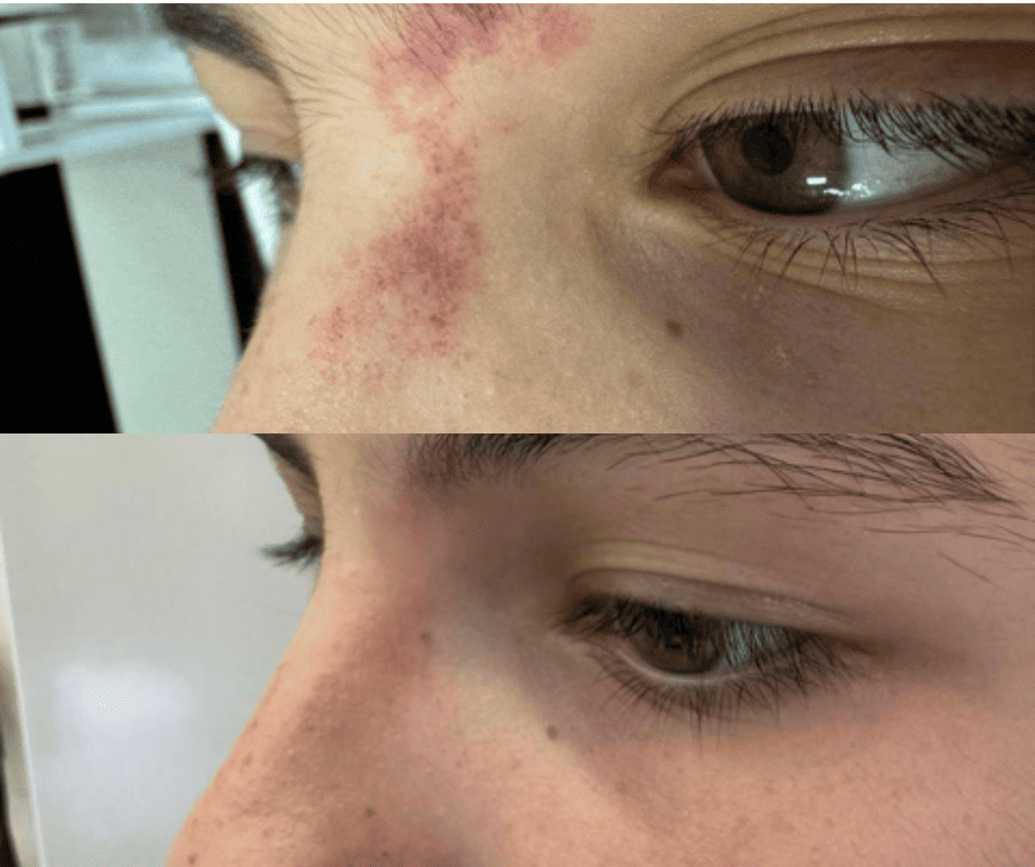 Удаление винных пятен - фото до и после процедуры в клинике косметологии Effi.