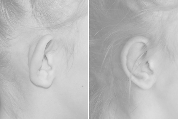 Коррекция оттопыренных ушей (лопоухости)