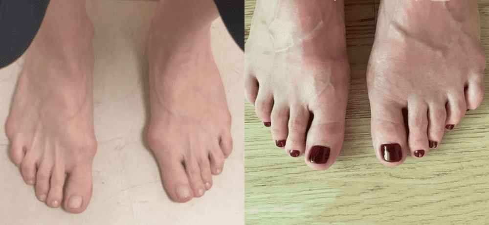 Операция лечения вальгусной деформации стопы (Hallus Valgus) - фото до и после операции  по выпрямлению  большого пальца в клинике косметологии Effi в Красноярске.