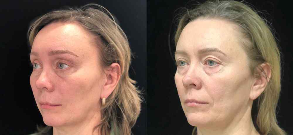 Чик лифтинг - фото до и после операции  в клинике косметологии Effi в Красноярске. Подтяжка лица: убрали мешки под глазами, носогубные складки, обвисшую и дряблую кожу, подтянули веки и уголки глаз, а также подтянули овал лица