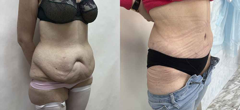 Абдоминопластика живота - фото до и после операции абдоминопластики живота и боков в клинике косметологии Effi - врач Семенов. Наши хирурги имеют многолетний опыт работы.