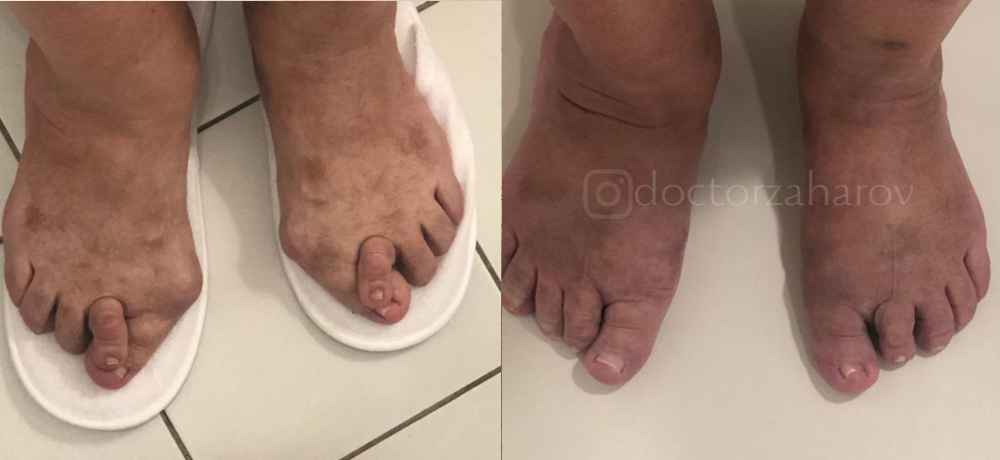 Операция лечения вальгусной деформации стопы (Hallus Valgus) - фото до и после операции в клинике косметологии Effi в Красноярске.