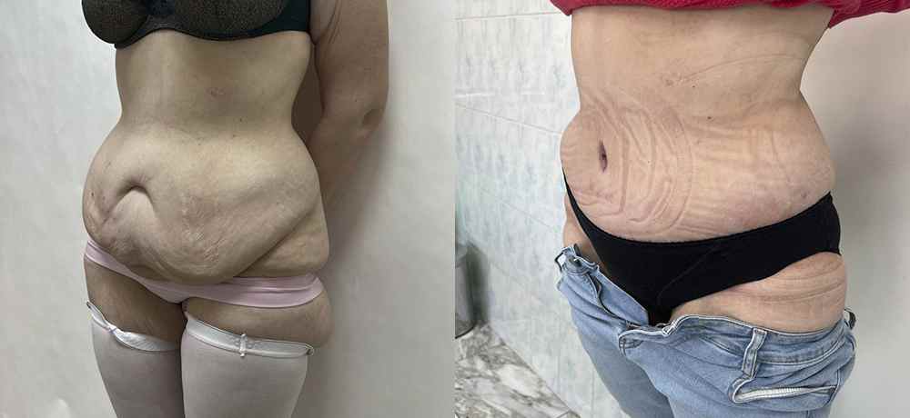 Абдоминоплатсика + липосакция живота - фото до и после  операции липосакции живота и боков в клинике косметологии Effi в Красноярске - врач Семенов. Наши хирурги имеют многолетний опыт работы.
