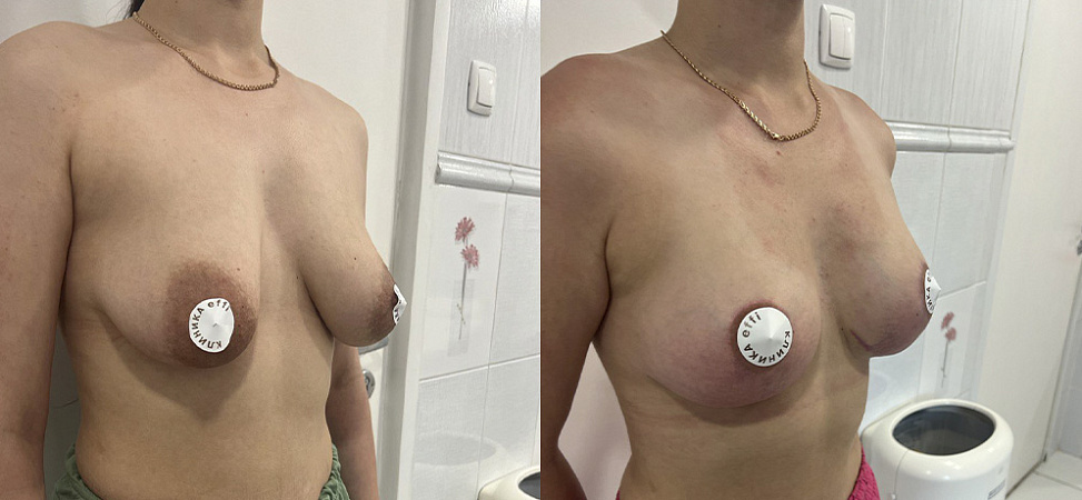 Фото до и после Увеличение груди