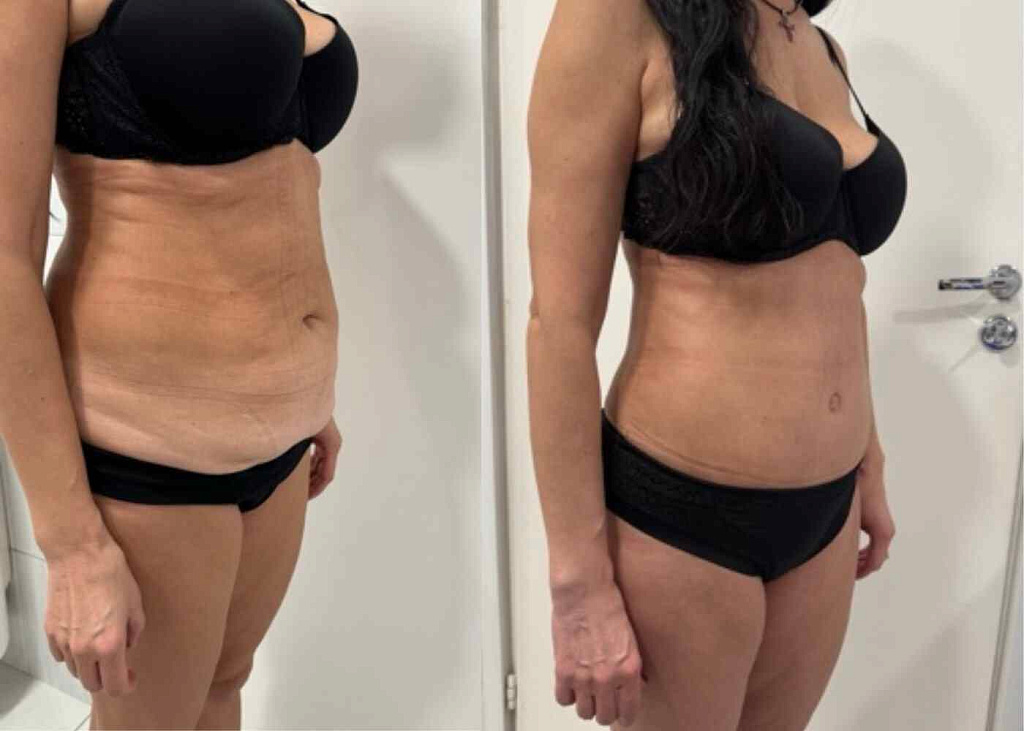 Абдоминопластика, липосакция боков, спины, живота, небольшой липофилинг ягодиц результат после 2 месяцев - фото до и после операции в клинике  косметологии Effi в Красноярске.