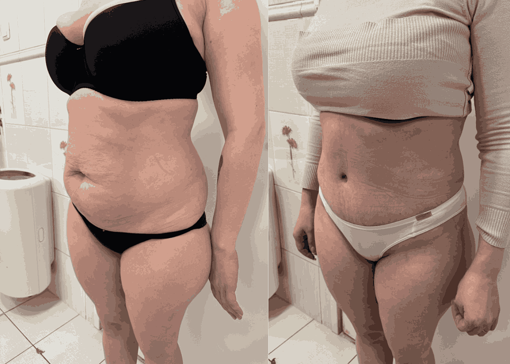 Абдоминопластика живота - фото до и после  операции живота и боков в клинике косметологии Effi - врач Семенов. Наши хирурги имеют многолетний опыт работы.