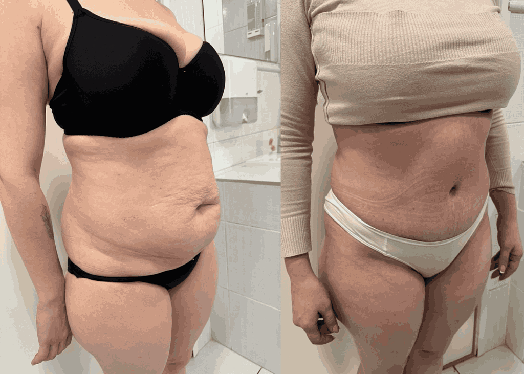 Абдоминопластика + липосакция результат после 4 месяцев - фото до и после процедуры в клинике  косметологии Effi в Красноярске. На фото у пациентки видно как уменьшился живот