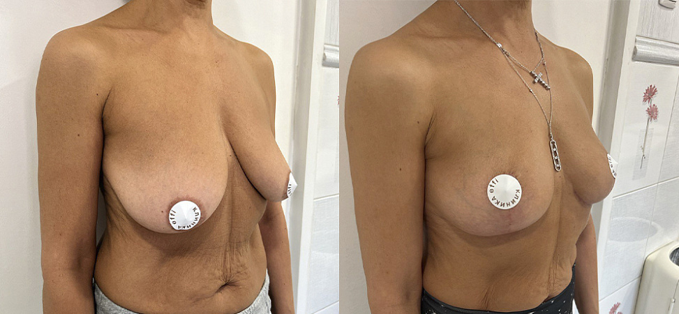 Фото до и после Подтяжка груди