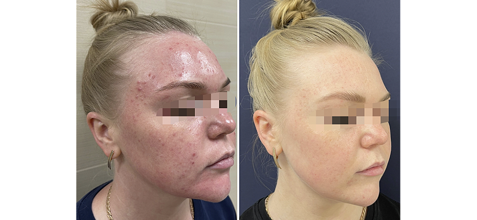 Фото до и после Лечение угрей