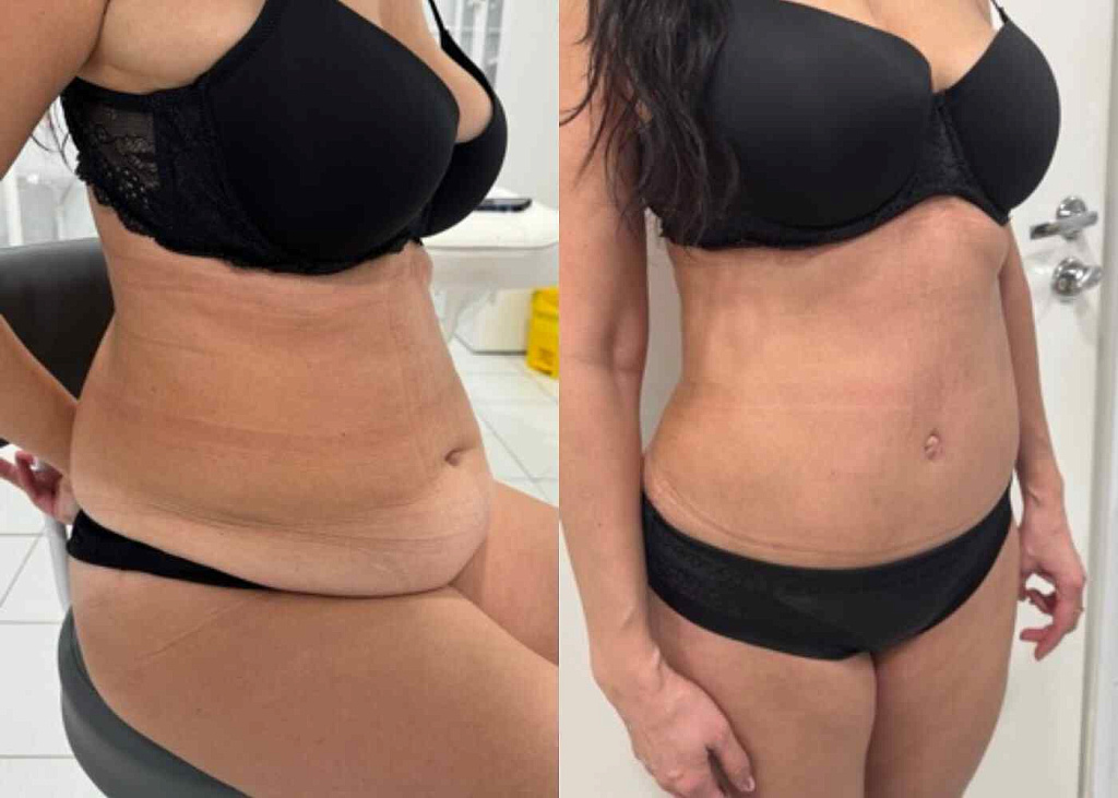 Абдоминопластика, липосакция боков, спины, живота, небольшой липофилинг ягодиц результат после 2 месяцев - фото до и после процедуры в клинике  косметологии Effi в Красноярске. На фото у пациентки результат после 2 месяцев реабилитации