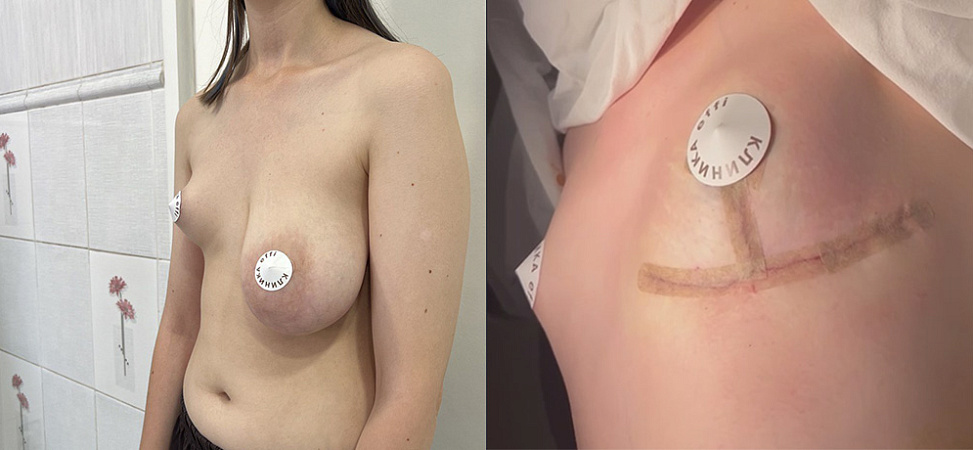 Фото до и после Уменьшение груди