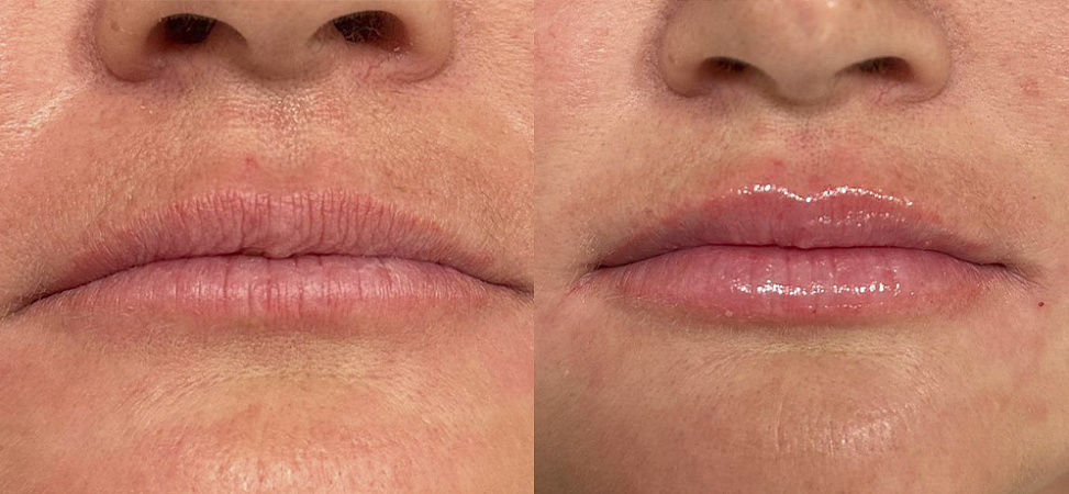 Фото до и после Увеличение губ