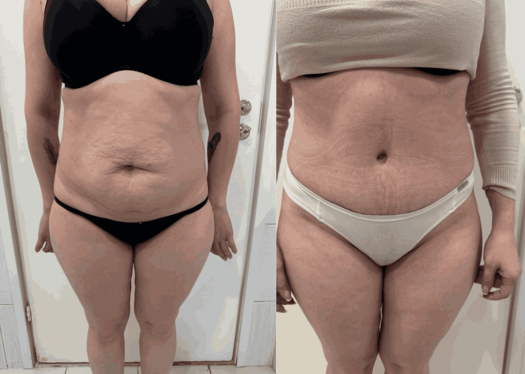 Абдоминопластика + липосакция результат после 4 месяцев - фото до и после процедуры в клинике  косметологии Effi в Красноярске.