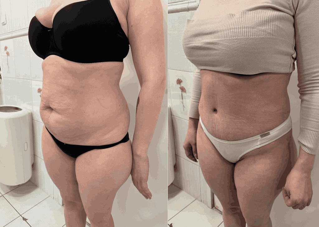 Абдоминопластика + липосакция- фото до и после процедуры в клинике  косметологии Effi в Красноярске.