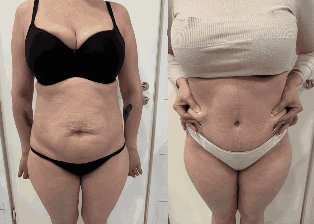 Абдоминопластика + липосакция результат после 4 месяцев - фото до и после процедуры в клинике  косметологии Effi в Красноярске. На фото у пациентки видно как уменьшился живот фото с боку