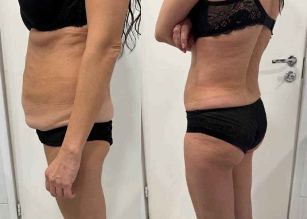 Абдоминопластика, липосакция боков, спины, живота, небольшой липофилинг ягодиц результат после 2 месяцев - фото до и после процедуры в клинике  косметологии Effi в Красноярске.