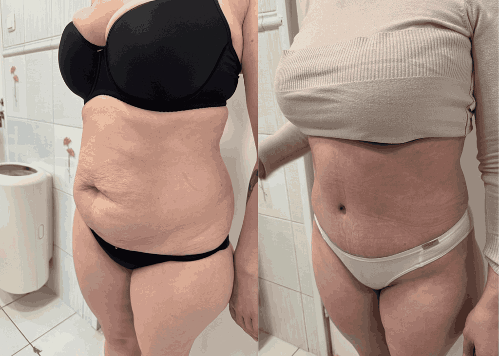 Абдоминопластика + липосакция результат после 4 месяцев - фото до и после процедуры в клинике  косметологии Effi в Красноярске. На фото у пациентки видно как уменьшился живот, талия стала более тонкой, фото с боку
