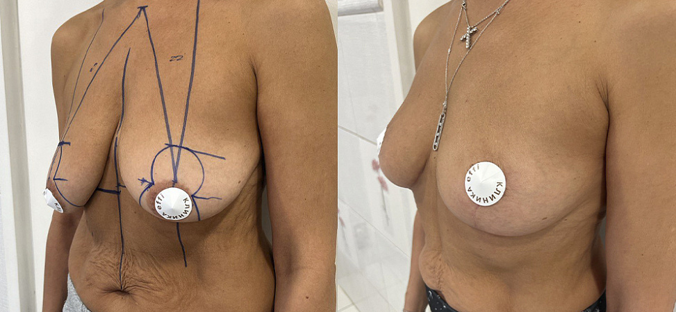 Фото до и после Подтяжка груди