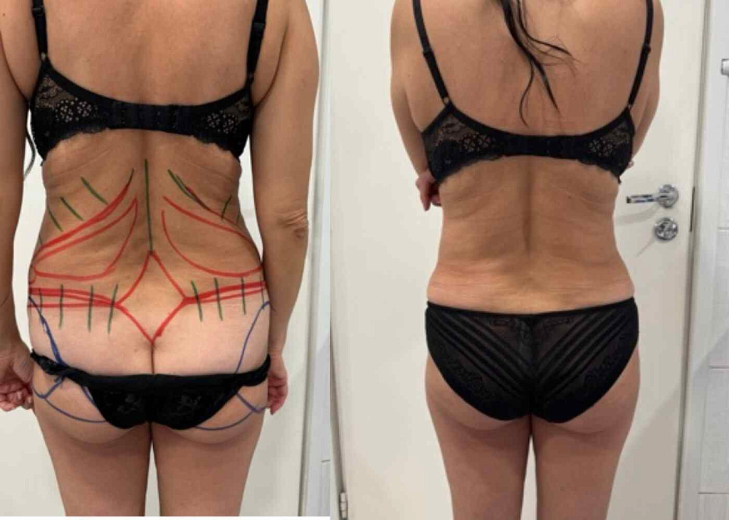 Абдоминопластика, липосакция боков, спины, живота, небольшой липофилинг ягодиц результат после 2 месяцев - фото до и после операции в клинике  косметологии Effi в Красноярске. На фото у пациентки заметно уменьшился объем в талии, подтянули кожу в области