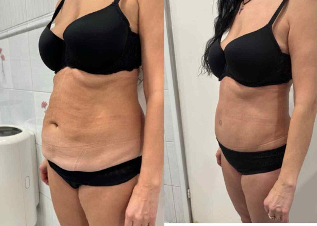 Абдоминопластика, липосакция боков, спины, живота, небольшой липофилинг ягодиц результат после 2 месяцев - фото до и после операции в клинике  косметологии Effi в Красноярске. На фото у пациентки заметно уменьшился объем в талии