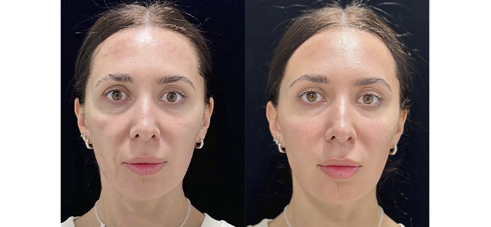 Фото до и после Контурная пластика лица