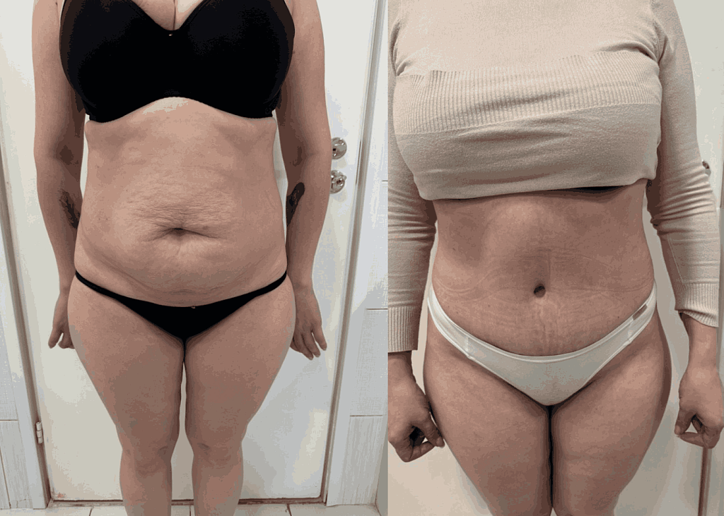 Абдоминопластика + липосакция результат после 4 месяцев - фото до и после процедуры в клинике  косметологии Effi в Красноярске. На фото у пациентки видно как уменьшился живот, талия стала более тонкой