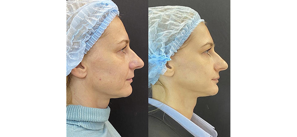 Фото до и после Лазерная шлифовка лица