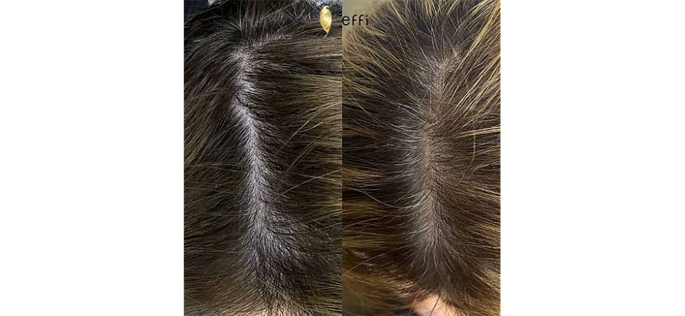Фото до и после Мезотерапия для волос