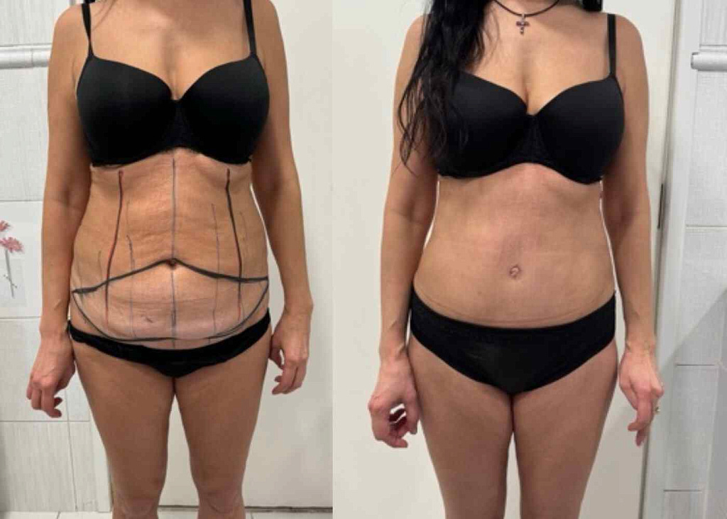 Абдоминопластика, липосакция боков, спины, живота, небольшой липофилинг ягодиц результат после 2 месяцев - фото до и после операции в клинике  косметологии Effi в Красноярске. На фото у пациентки заметно уменьшился объем в талии, подтянули кожу в области